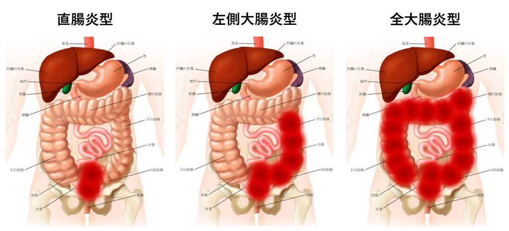大腸のみに起こる連続性の浅い炎症